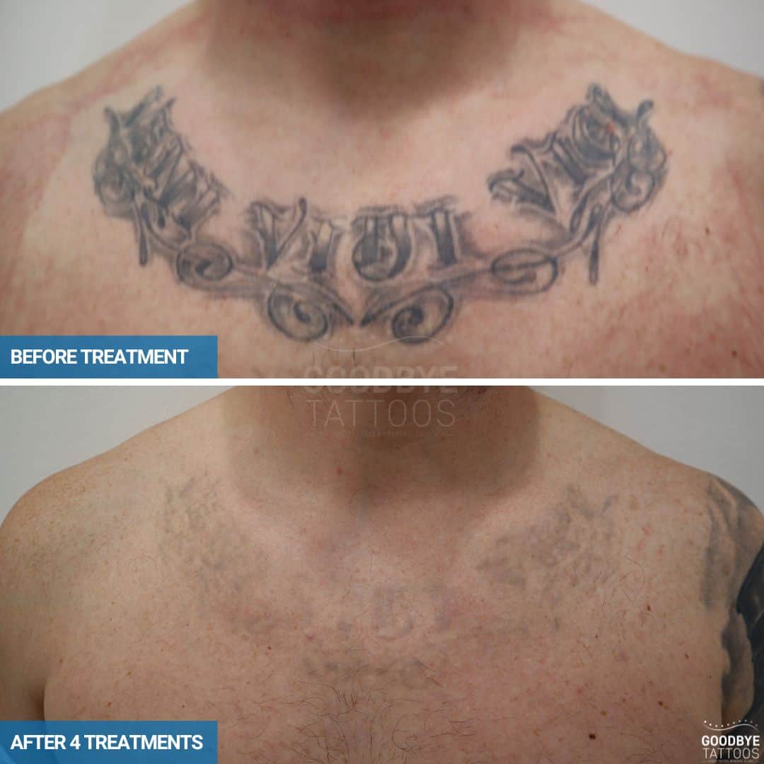 Laser tattoo removal progress photo of a bla