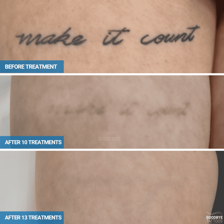 Tattoo Removal Before and After Photos | Goodbye Tattoos