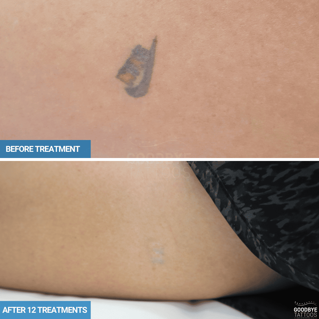 Tattoo removal progress after 12 laser treatments on a small Nike logo tattoo.