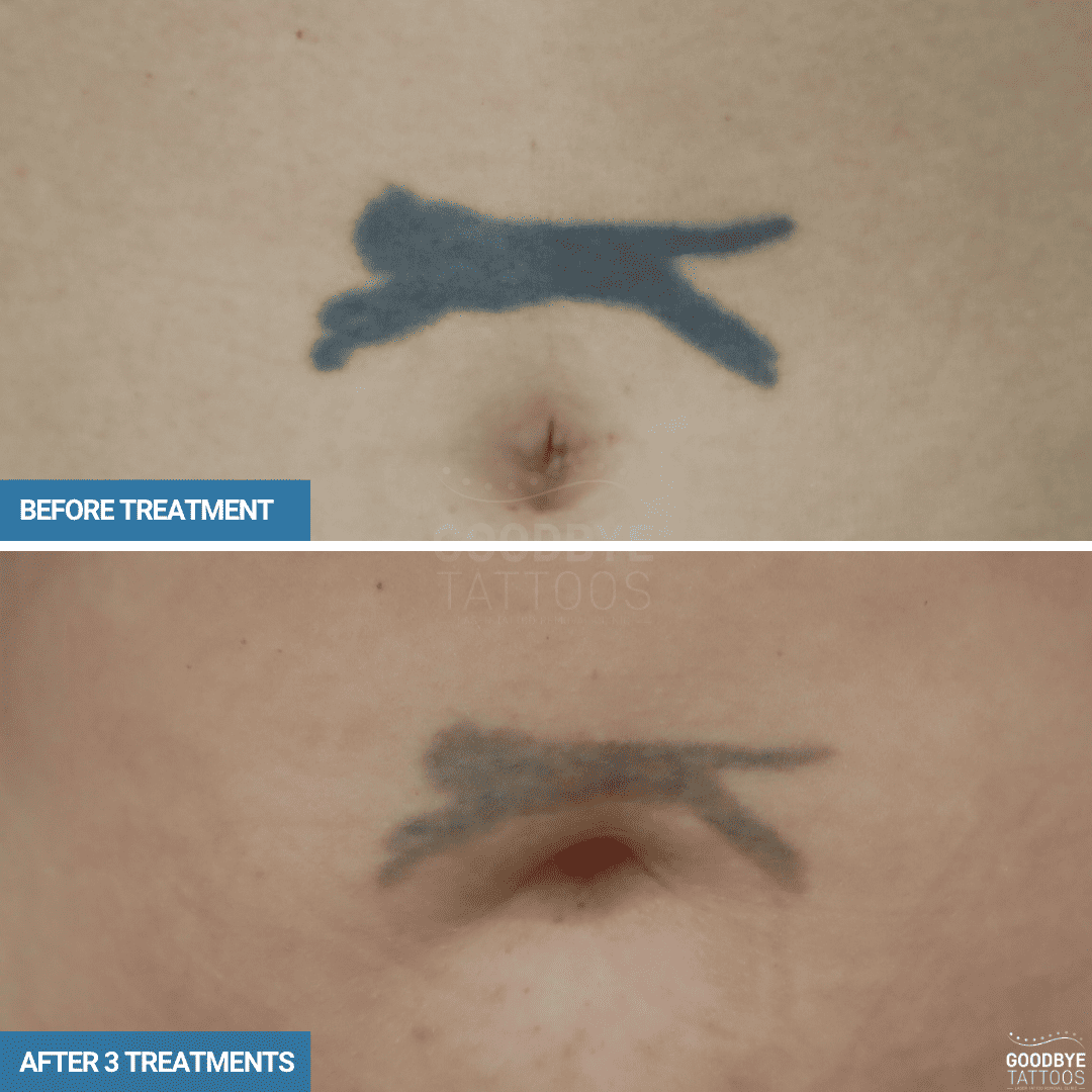 Tattoo removal progress photo of a black ink panther on the stomach.