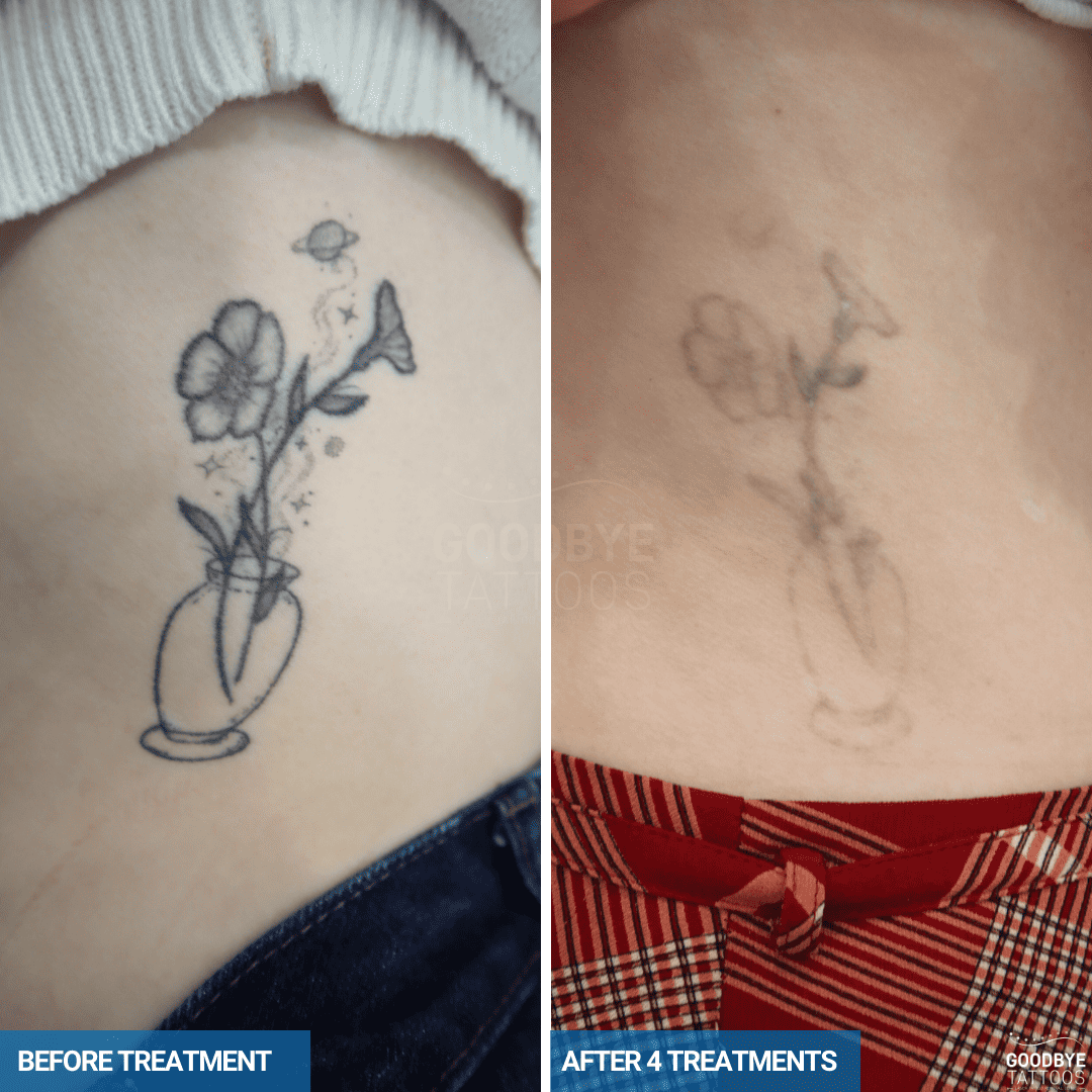 Tattoo removal faded flower