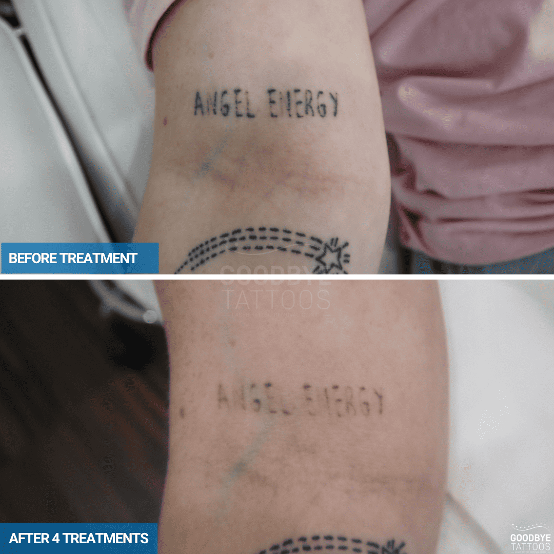Before and after laser tattoo removal of a tattoo on the arm reading 'Angel Energy', showing progress after four treatments.