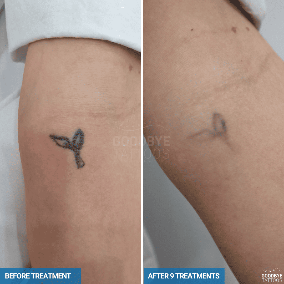 Before and after laser tattoo removal progress of a black ink leaf tattoo on the arm, showing fading after six treatments.