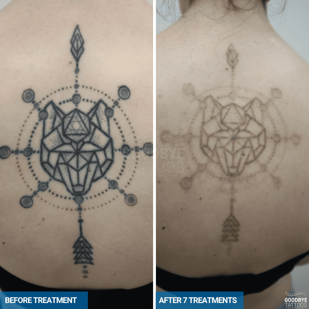 Laser tattoo removal progress photo of a black back tattoo Aztec maze.