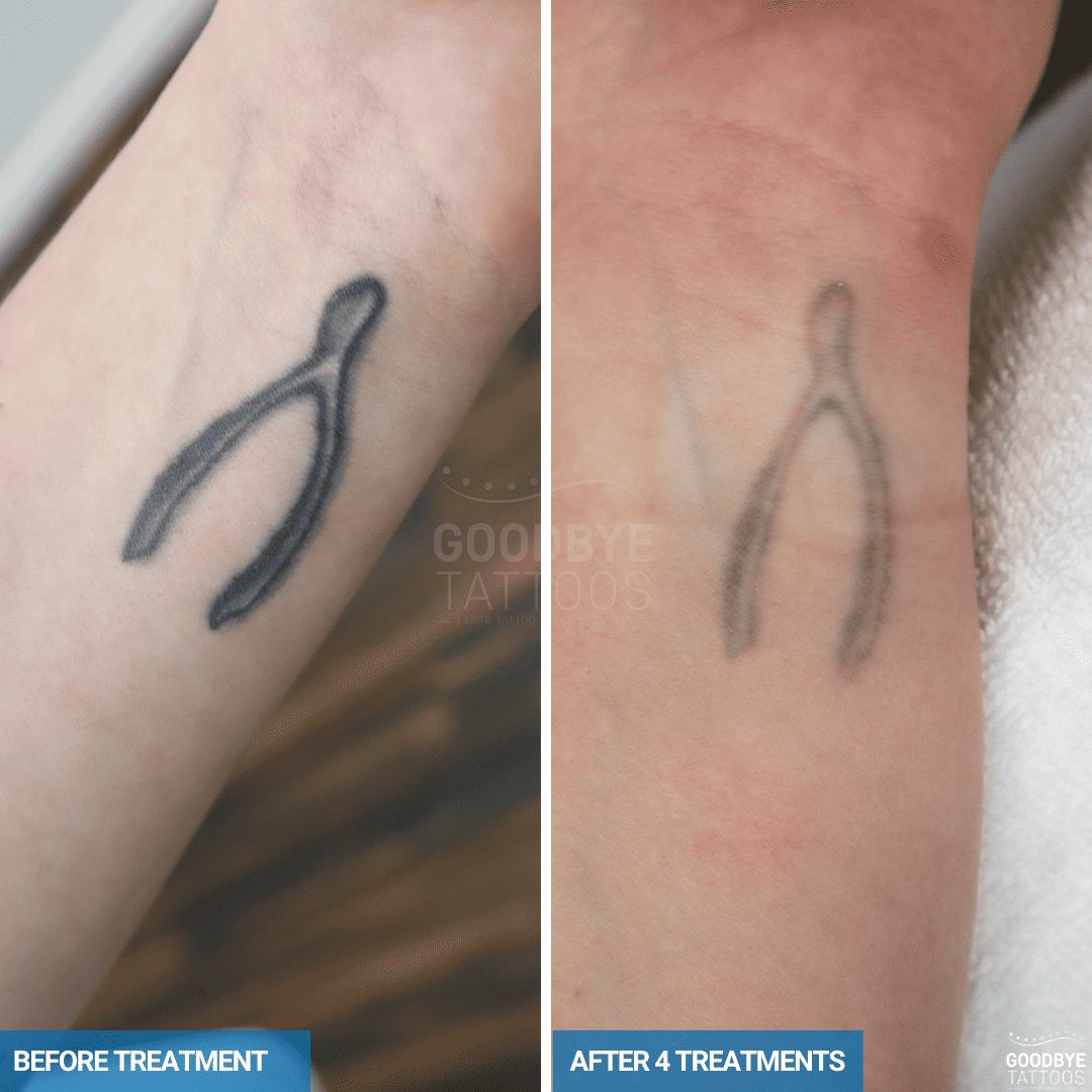 Before and after laser tattoo removal progress of a black ink tattoo of a wishbone, showing fading after three treatments.