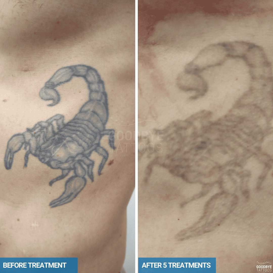 Before and after comparison showing laser tattoo removal progress of a large scorpion tattoo on the chest.