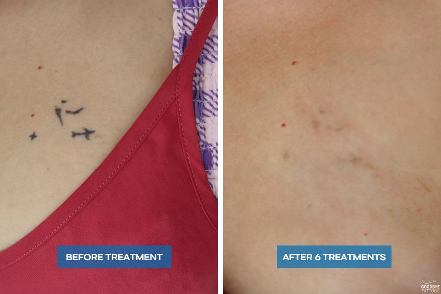 Black Ink Removal on Chest Tattoo