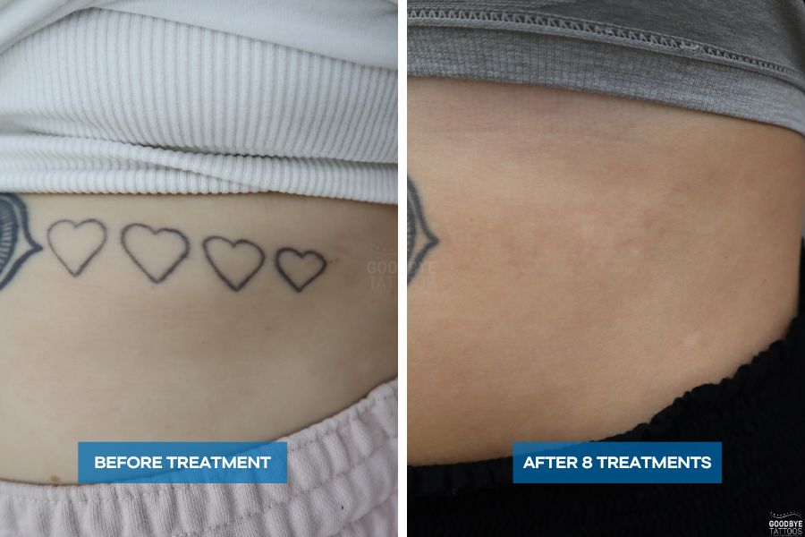 Tattoo removal progress photo of black inked hearts on an abdomen
