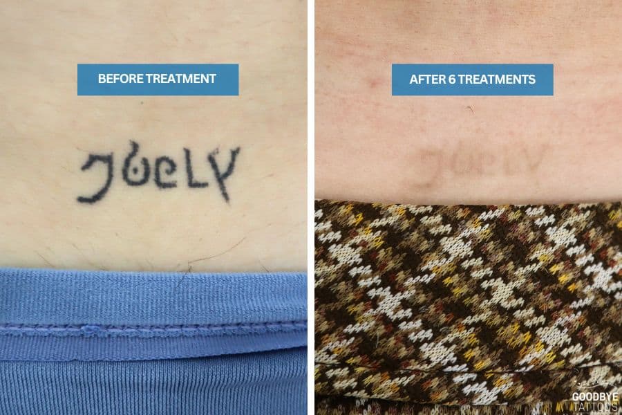 Removal after only 6 treatments of an ex's name