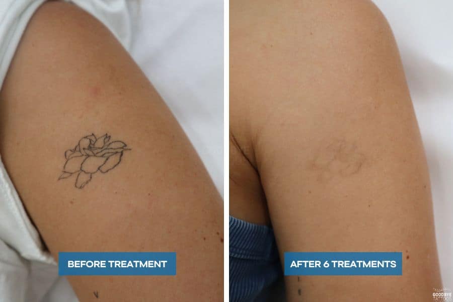 Close-up of Tattoo Fading Progress on Skin