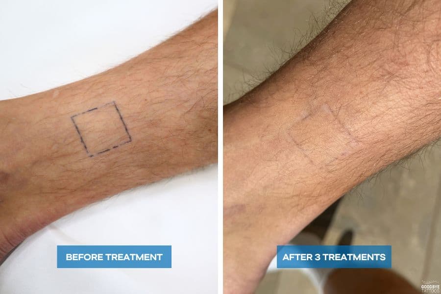 Tattoo Removal progress photo showing before and after three treatments on an leg