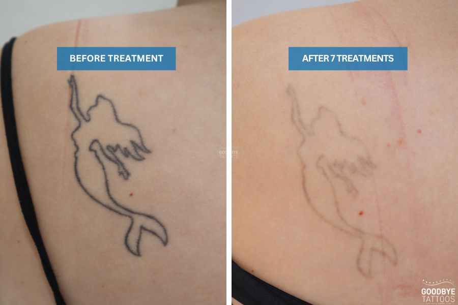 Progress photo showing tattoo removal results before and after treatment.