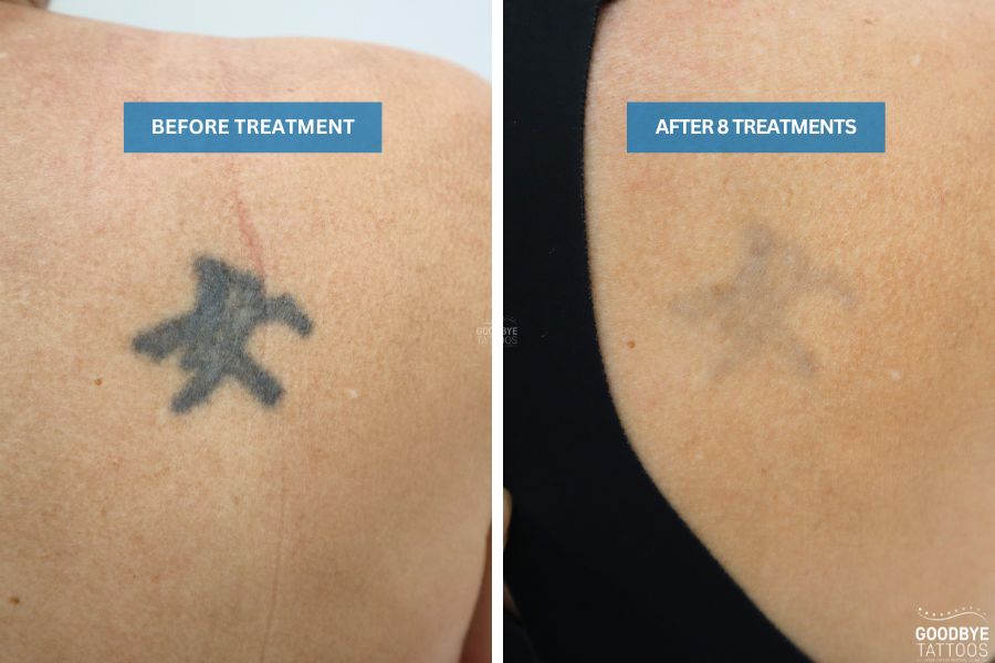 Tattoo removal progress shown in before and after treatment images.