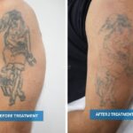 Image showing the process of tattoo fading after two treatments on an upper arm