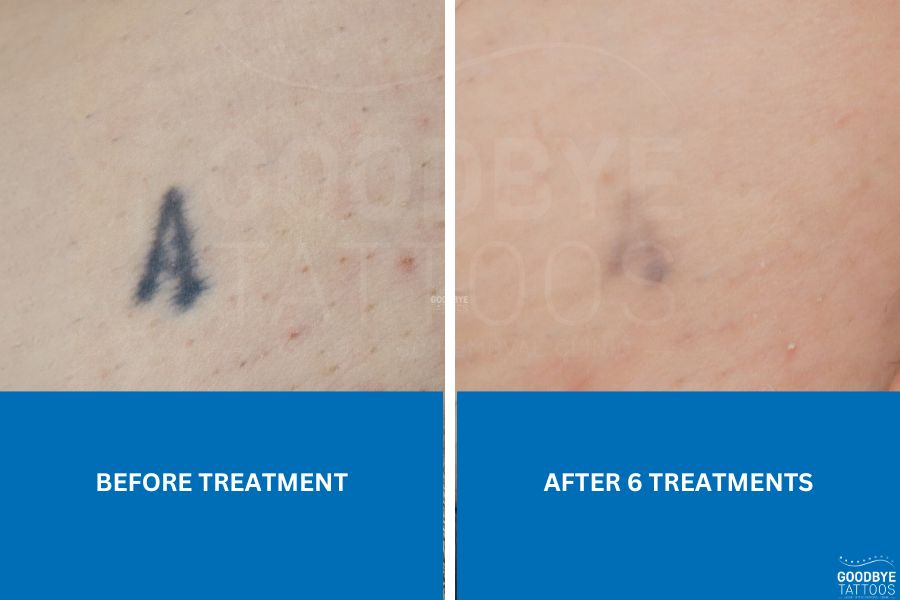 Tattoo removal services featuring a before and after image of six laser treatments.