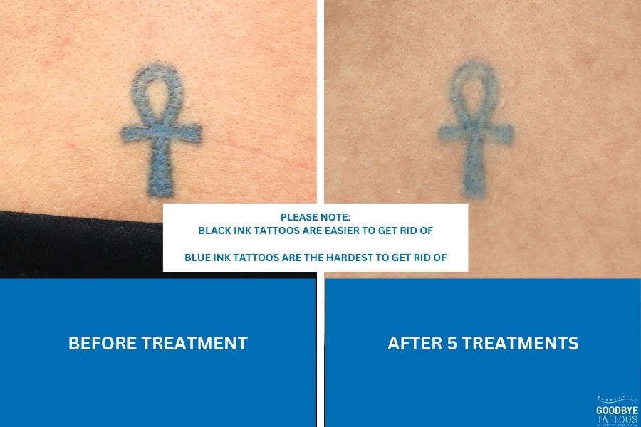 Before and after results of a blue ink tattoo removal service showcasing the progress over five treatments.