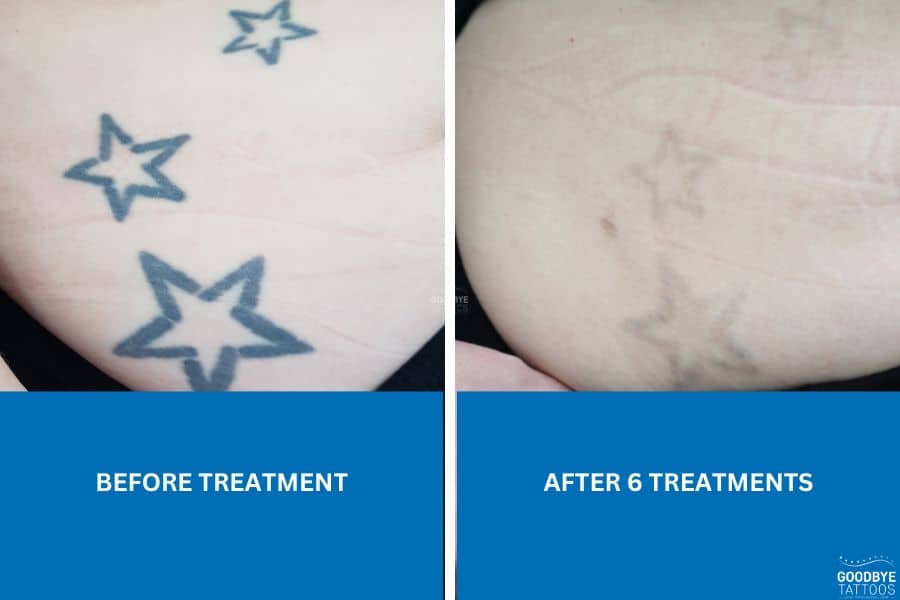 Image showing tattoo fading before and after six treatments for tattoo removal.