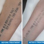 Close-up of an arm undergoing tattoo removal treatment, showing before and after results.