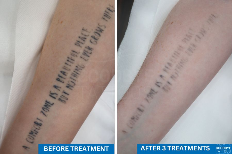Close-up of an arm undergoing tattoo removal treatment, showing before and after results.