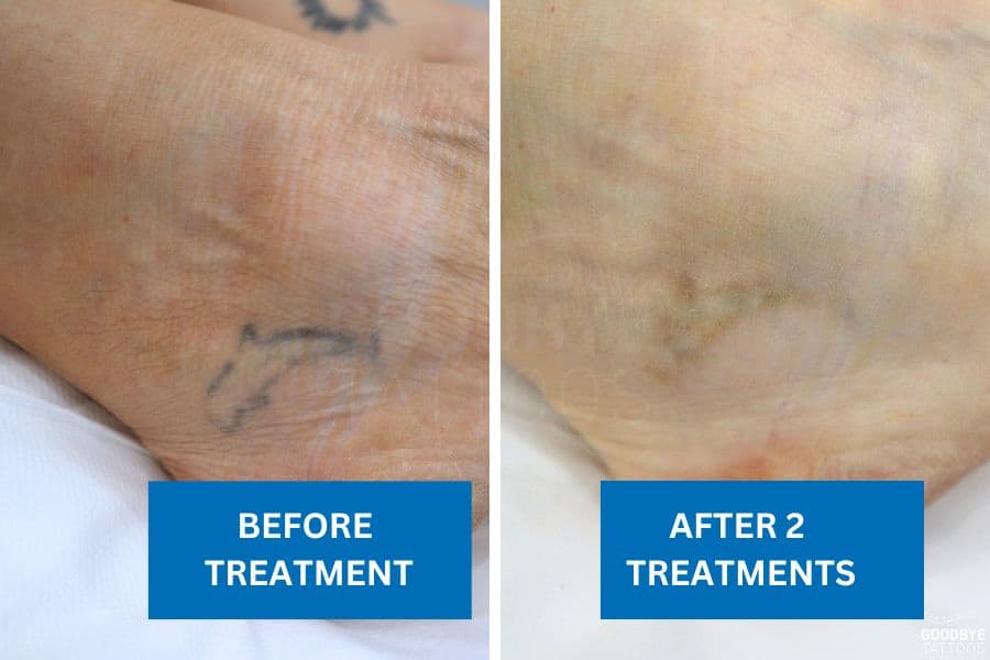 Before and after comparison of a tattoo removal treatment on a foot, showing visible fading after two sessions.