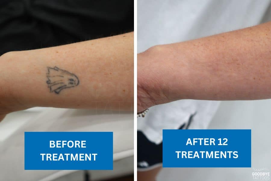 Before and after comparison of a ghost tattoo removal, showing results after 12 treatments.