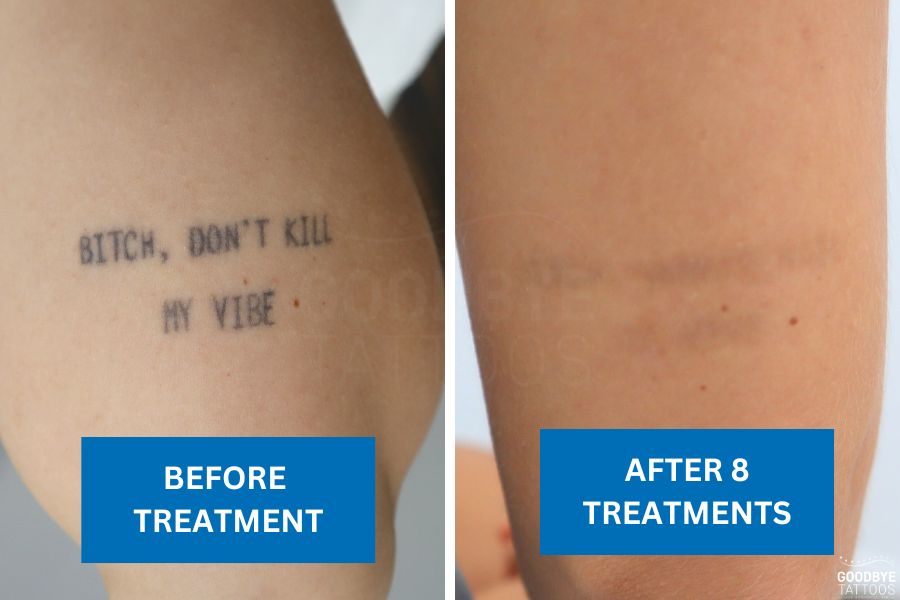 Laser tattoo fading treatment demonstrating progressive ink removal over multiple sessions.