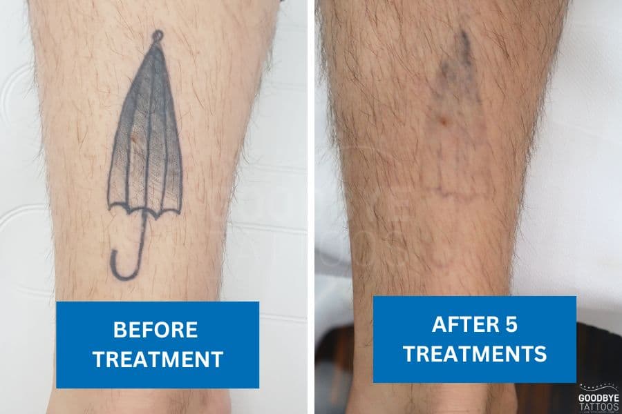 A before-and-after comparison of a closed umbrella tattoo removal on a person's leg, showing progress after five treatments.