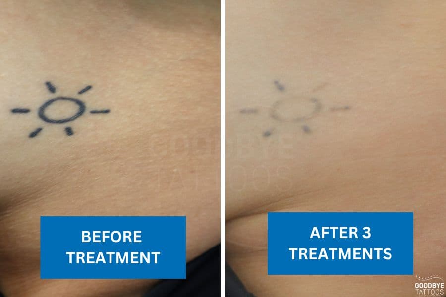 Before and after comparison showing tattoo fading progress, with a sun tattoo significantly lightened after three treatments.