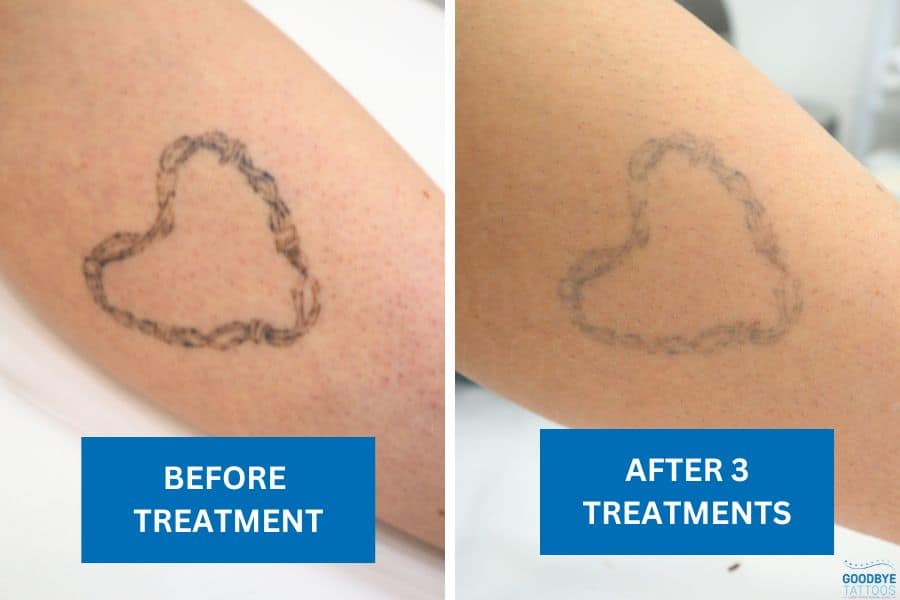 Laser tattoo removal on a heart-shaped design showing results after three sessions