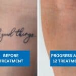 Before and after image showing complete fading of a script tattoo two years after tattoo removal treatment.