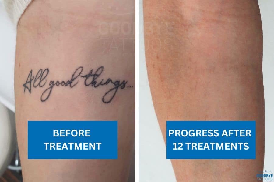 Before and after image showing complete fading of a script tattoo two years after tattoo removal treatment.