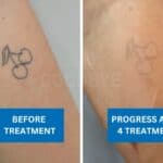 Tattoo removal progress showing fading of cherry tattoo after four treatments