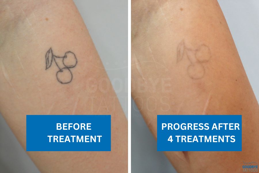 Tattoo removal progress showing fading of cherry tattoo after four treatments