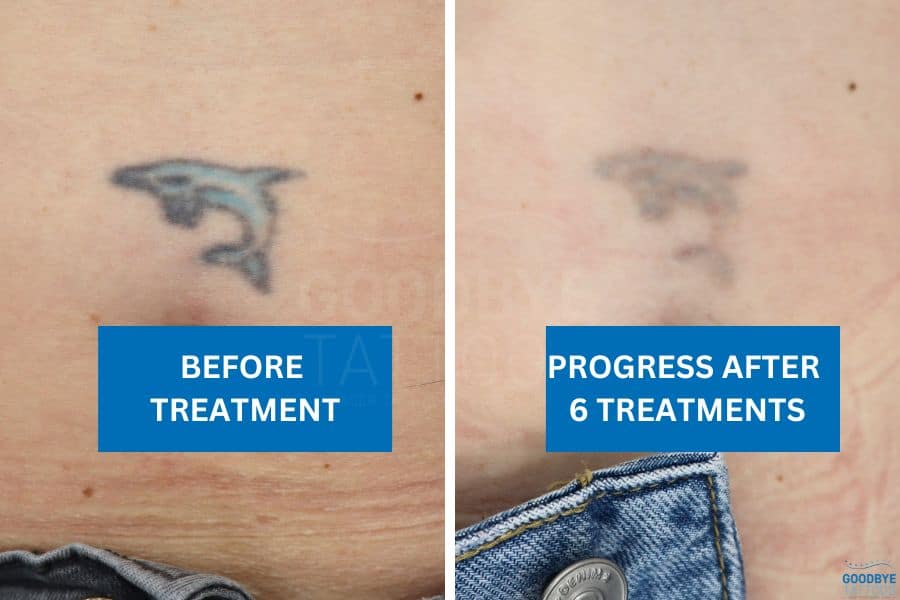 Before and after progress of dolphin tattoo fading after six tattoo removal treatments
