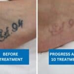 Before and after photo of black tattoo on foot showing fading after 10 laser tattoo removal treatments.