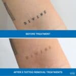 Word tattoo on arm showing fading after five tattoo removal treatments