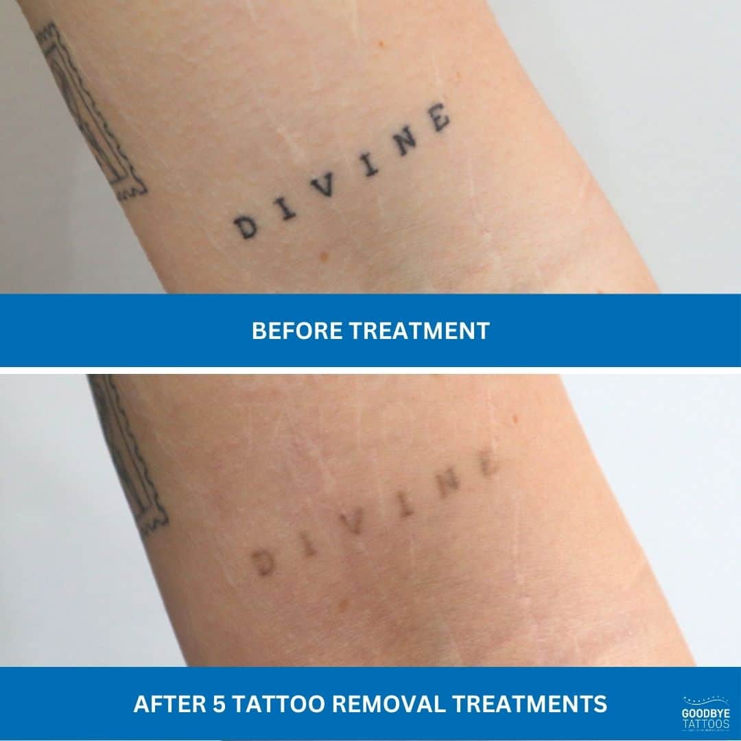 Word tattoo on arm showing fading after five tattoo removal treatments