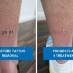 Ankle tattoo removal showing before and after fading results