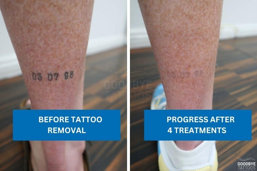Ankle tattoo removal showing before and after fading results