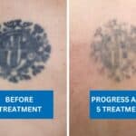 Back tattoo showing results of removal treatment after five sessions