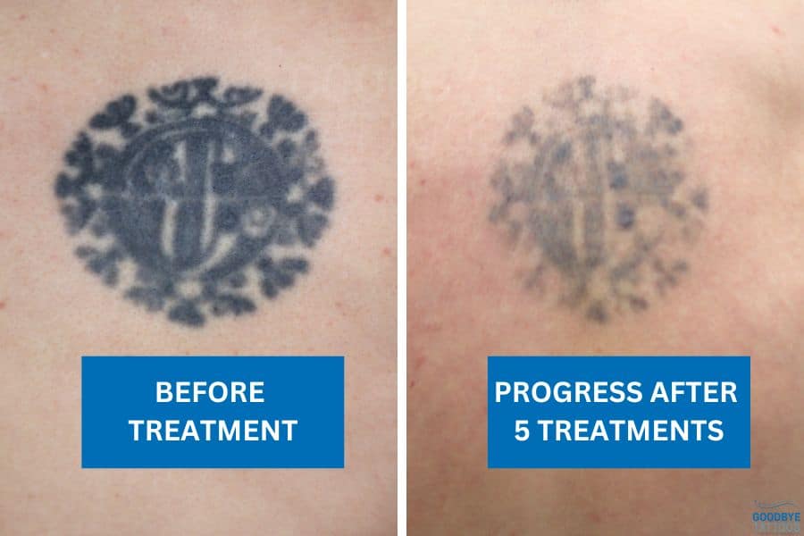 Back tattoo showing results of removal treatment after five sessions