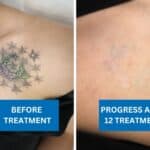 Tattoo removal showing progress on a multi-coloured flower tattoo after 12 treatments