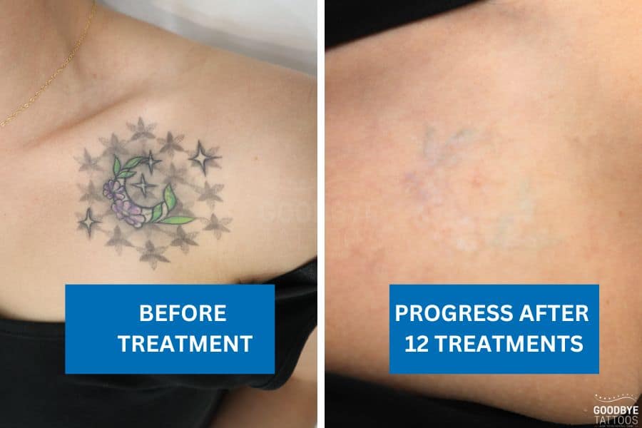Tattoo removal showing progress on a multi-coloured flower tattoo after 12 treatments