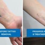 Wrist tattoo before and after six tattoo removal treatments showing faded music note design