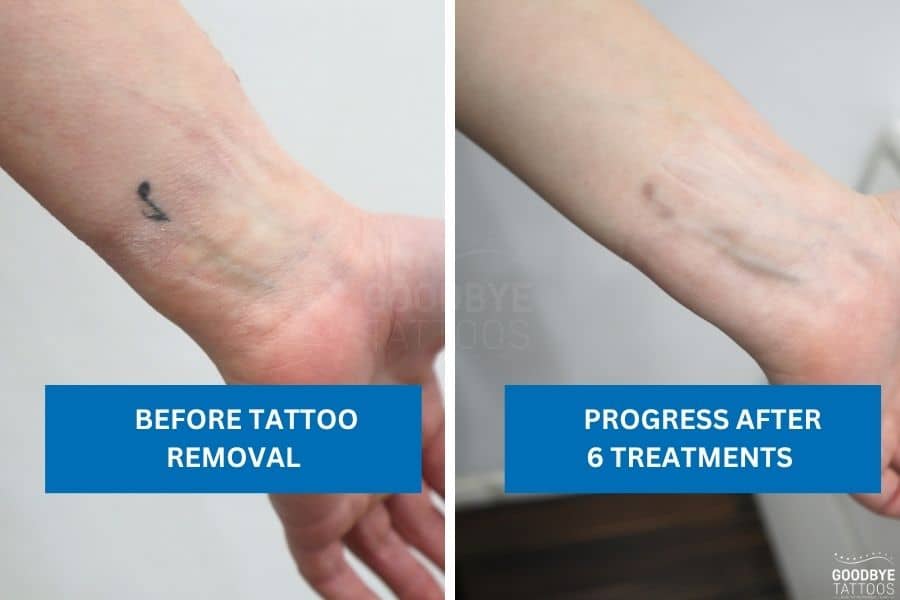 Wrist tattoo before and after six tattoo removal treatments showing faded music note design