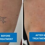 Before and after tattoo removal showing fading of a small plane tattoo on an arm after six tattoo removal treatments.