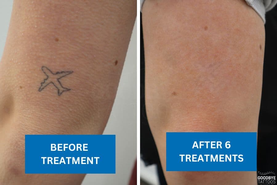 Before and after tattoo removal showing fading of a small plane tattoo on an arm after six tattoo removal treatments.