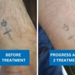 Faded cross tattoo on wrist after two tattoo removal treatments