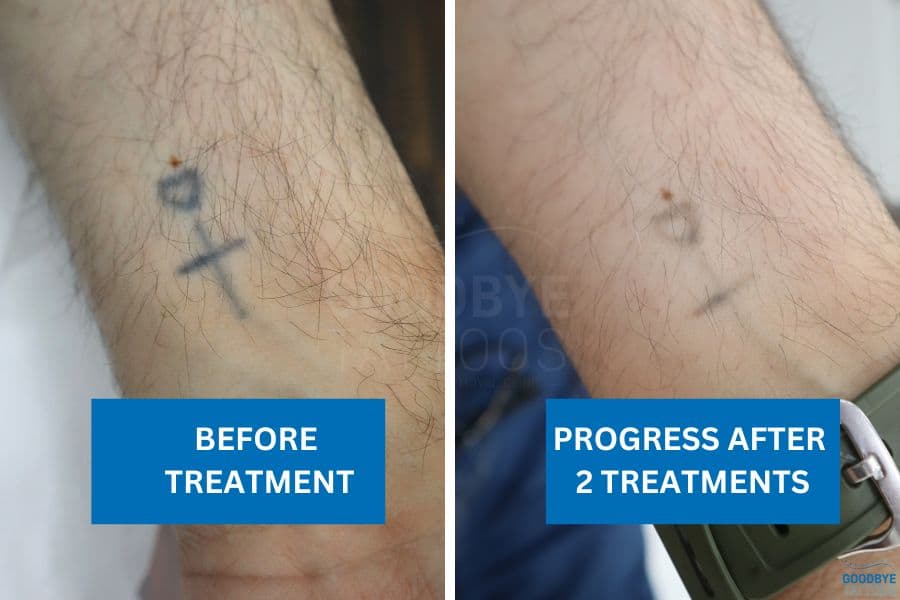 Faded cross tattoo on wrist after two tattoo removal treatments