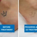 Before and after image showing fading of a crown tattoo on the foot after 10 laser tattoo removal treatments.
